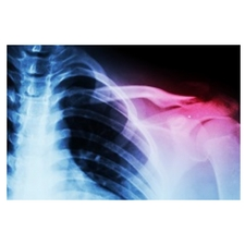 shoulder injury, shoulder surgery, pain, recovery, rehab, pre-op info session